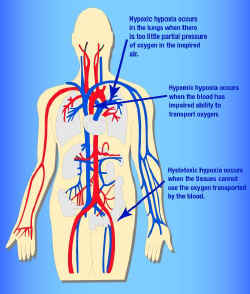 Types of hypoxia